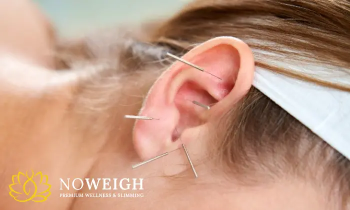 Acudetox Acupuncture Therapy – 2 Or 3 Sessions 1