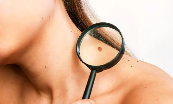 Professional Laser Mole Removal In Johannesburg At Laser Clinic Medical 1
