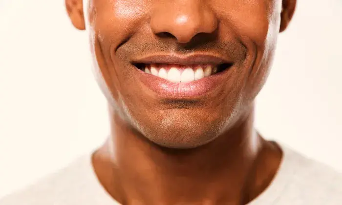 Professional Teeth Whitening Treatment 1