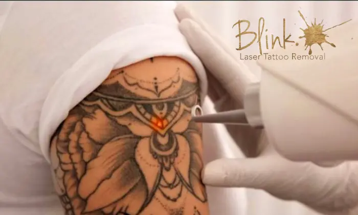 Single-Session Tattoo Or Skin Tag Removal Using Advanced Laser Technology 1