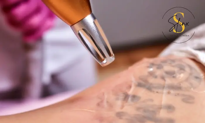 Tattoo Lightening Series: Six Professional Removal Sessions 1
